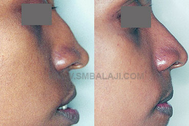 Best Nasal correction surgery of a nose